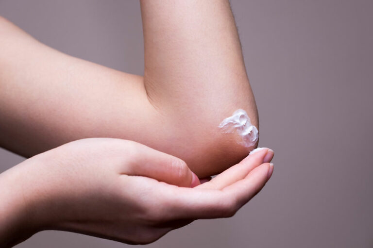 Atopic dermatitis – Causes, symptoms, and more